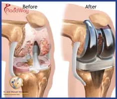 Slider image (6) Dr. Jose Manuel Hernandez - Orthopedic Surgery in Mexico